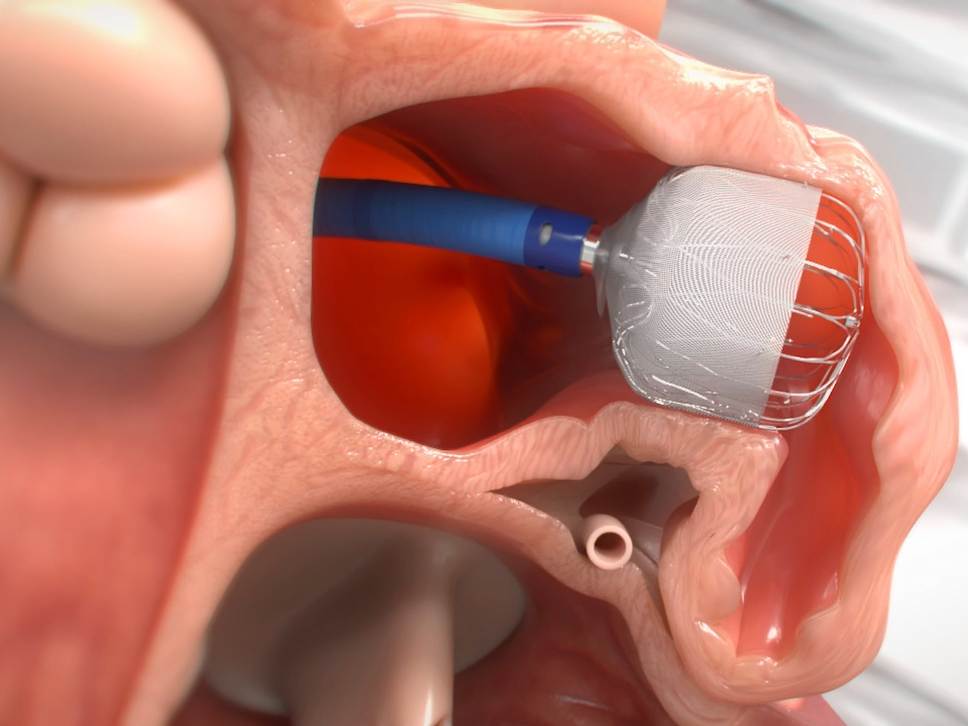 As shown in this model, the WATCHMAN implant is inserted into the patient’s left atrial appendage (LAA) in the heart through a small incision in the inner thigh, reducing the risk of stroke in AFib patients. –Photo credit Boston Scientific Corp.
